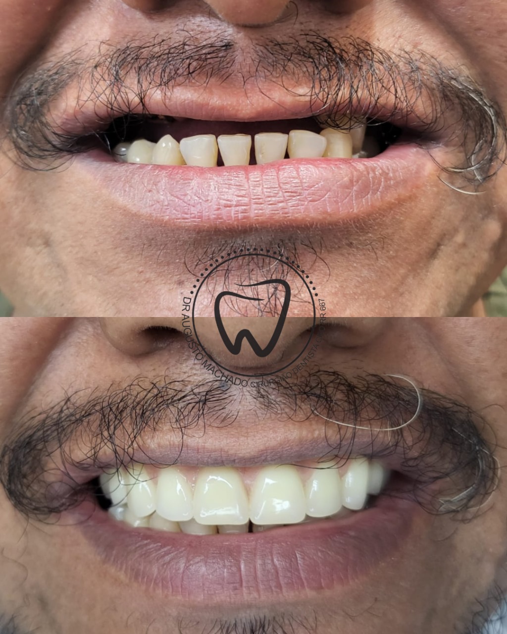 Antes e depois de tratamento odontológico, caso 1