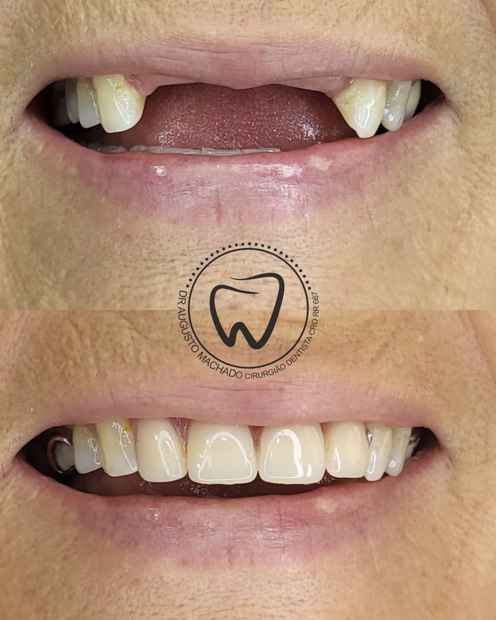 Antes e depois de tratamento odontológico, caso 2