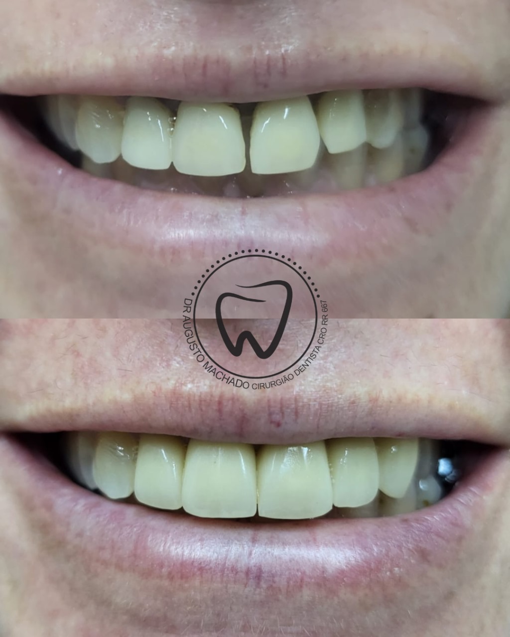 Antes e depois de tratamento odontológico, caso 3
