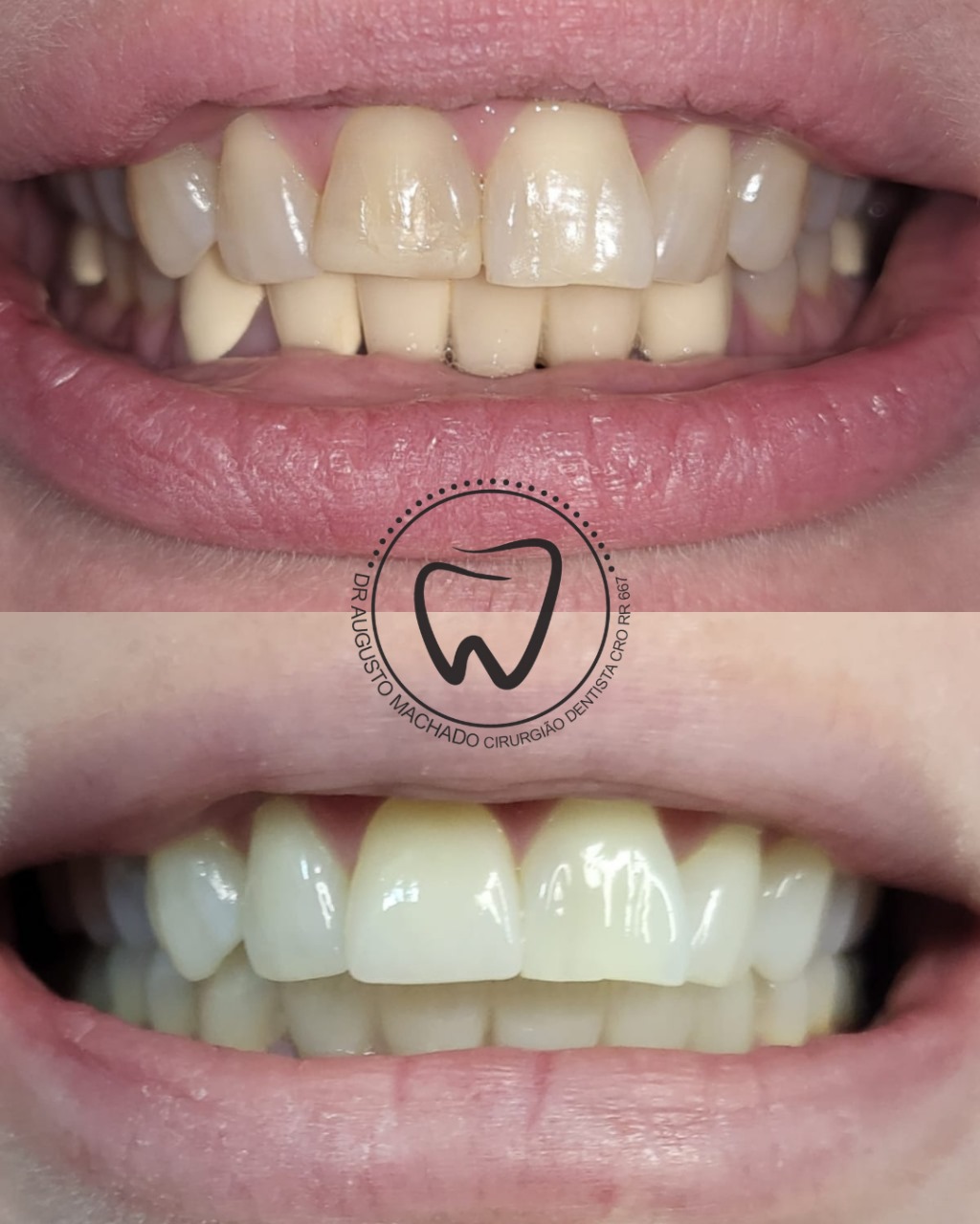 Antes e depois de tratamento odontológico, caso 4