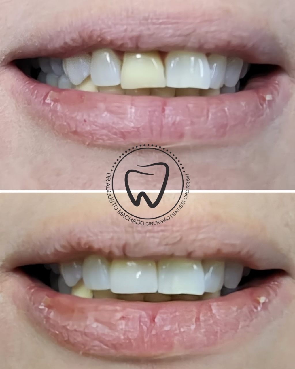 Antes e depois de tratamento odontológico, caso 5