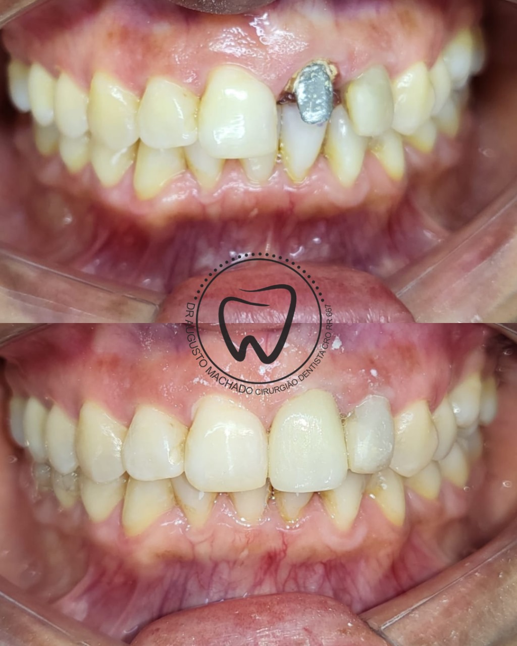 Antes e depois de tratamento odontológico, caso 6